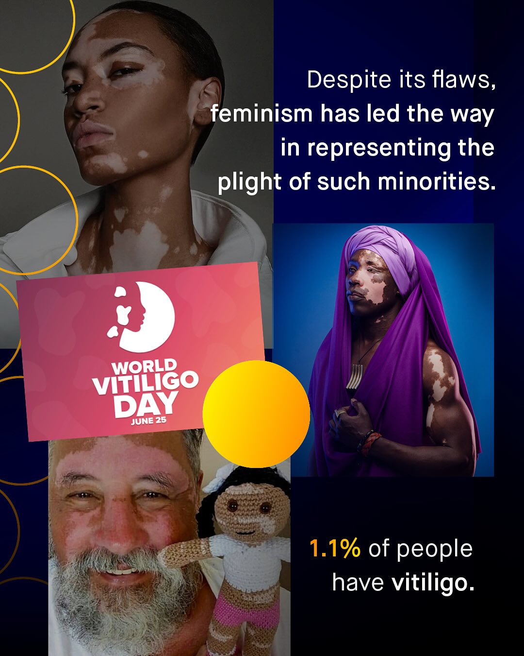 Despite its flaws, feminism has led the way in representing the plight of such minorities: WORLD vititico DAY 'JUNE 25 1.1% of people have vitiligo.